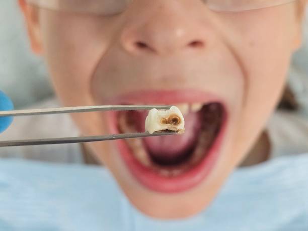 Best Emergency Dental Care for Broken or Chipped Teeth in Huntertown, IN