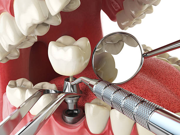 Best Emergency Tooth Extraction in Huntertown, IN